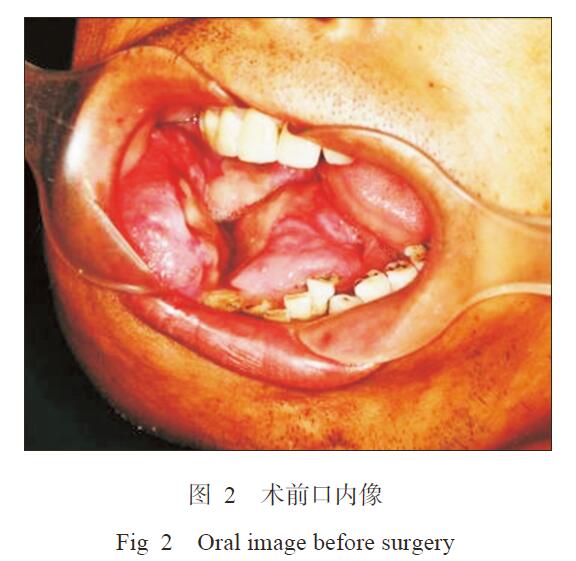 完善术前检查后,行右下颌骨中央性腺样囊性癌扩大切除术,右侧下颌骨